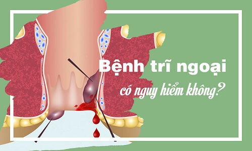 Bệnh trĩ ngoại có nguy hiểm không?